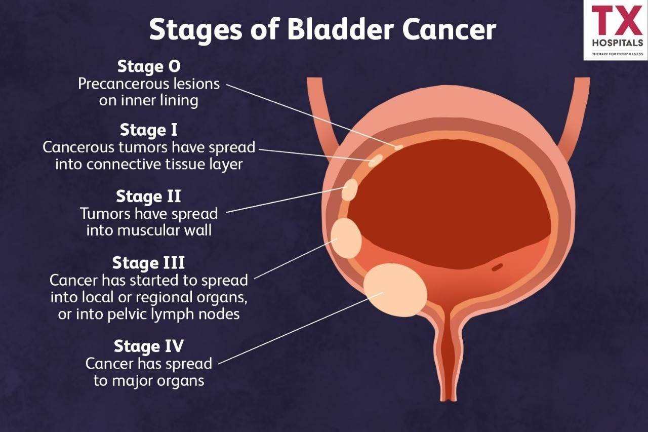 can-bladder-cancer-cause-nausea-updated