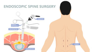 Endoscopic spine surgery1