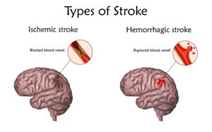 stroke, ischemic stroke, hemorrhagic stroke