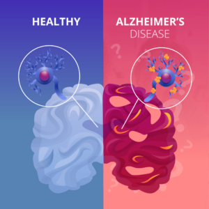 alzheimer’s disease