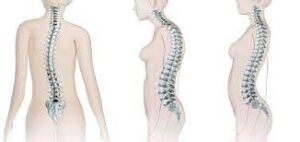 Symptoms The symptoms of spinal deformity can vary depending on the type and severity of the condition. Common symptoms may include: Abnormal curvature of the spine: This may manifest as sideways curvature (scoliosis), excessive forward curvature (kyphosis), or excessive backward curvature (lordosis). Visible changes in posture: Uneven shoulder or hip levels, protruding shoulder blades, or a hunched appearance. Back pain or discomfort: This can range from mild to severe and may be present during activities or even at rest. Restricted mobility: Spinal deformities can limit the range of motion and flexibility of the spine, leading to difficulties in performing certain movements or activities. Diagnosis Diagnosing a spinal deformity involves a thorough evaluation by healthcare professionals, often including orthopedic specialists or spine surgeons. Diagnostic procedures may include: Physical examination: The healthcare provider will assess the spine's curvature, observe the individual's posture, and check for any signs of abnormal alignment or asymmetry. Imaging tests: X-rays, MRI scans, or CT scans may be ordered to obtain detailed images of the spine, allowing for accurate measurement of the curvature and assessment of any underlying structural abnormalities. Treatment The treatment for spinal deformity depends on several factors, including the type, severity, and progression of the condition, as well as the individual's age and overall health. Treatment options may include: Observation: In mild cases of spinal deformity that are not progressive and do not cause significant symptoms, regular monitoring may be recommended. Bracing: For moderate spinal deformities, especially in growing children and adolescents, bracing may be prescribed. The brace helps slow down or prevent further progression of the curvature by providing external support to the spine. Physical Therapy and Exercises: Specific exercises and physical therapy techniques can help improve posture, strengthen core muscles, and increase flexibility. These exercises are often tailored to the individual's specific spinal deformity and overall condition. Surgical Intervention: In severe cases of spinal deformity or when other treatments have been ineffective, surgery may be considered. Surgical procedures aim to correct the spinal curvature, stabilize the spine, and alleviate associated symptoms. Lifestyle Changes Living with a spinal deformity may require making certain lifestyle adjustments: Posture Awareness: Maintaining good posture and body mechanics throughout daily activities can help alleviate discomfort and reduce the strain on the spine. Regular Exercise: Engaging in regular physical activity, under the guidance of healthcare professionals, can help improve strength, flexibility, and overall spinal health. Pain Management: Implementing pain management techniques, such as applying heat or cold packs, taking prescribed medications, or receiving physical therapy, can help alleviate back pain or discomfort associated with spinal deformity. Emotional Support: Coping with the physical and emotional challenges of living with a spinal deformity can be overwhelming. Seeking support from loved ones, joining support groups, or seeking professional counseling can provide valuable emotional support and coping strategies. Assistive Devices: Depending on the severity of the spinal deformity and associated mobility limitations, using assistive devices such as braces, orthotics, or mobility aids may be beneficial for maintaining stability and independence. It is essential to work closely with healthcare professionals to develop a personalized treatment plan for spinal deformity. Regular follow-ups, adherence to prescribed treatments and exercises, and implementing lifestyle changes can help manage symptoms, improve functionality, and enhance overall well-being. Spinal deformity