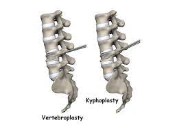 Kyphoplasty and vertebroplasty