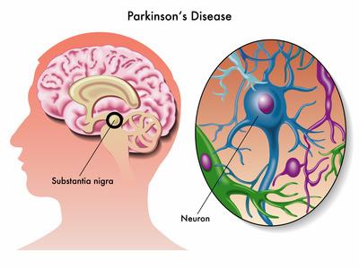 Parkinson's Disease Treatment in Hyderabad | Neurological Care