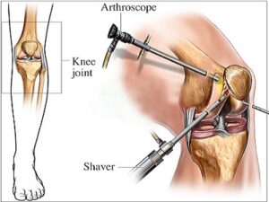 Arthroscopic Joint Surgery