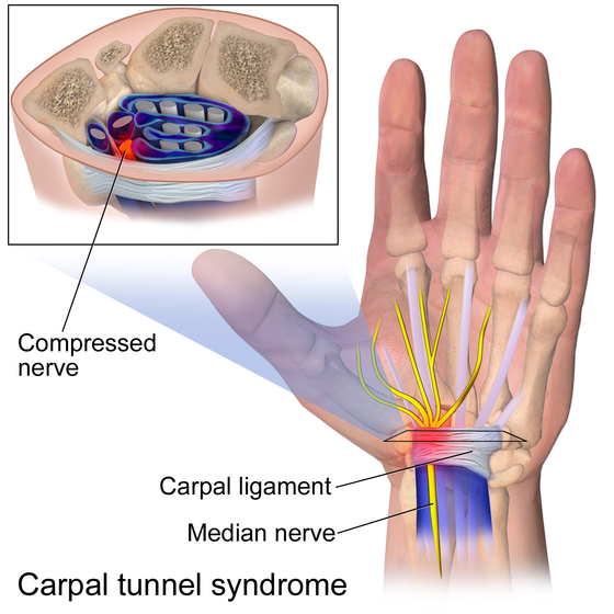 Carpal Tunnel Syndrome Surgery
