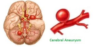 Cerebral Aneurysm Surgery