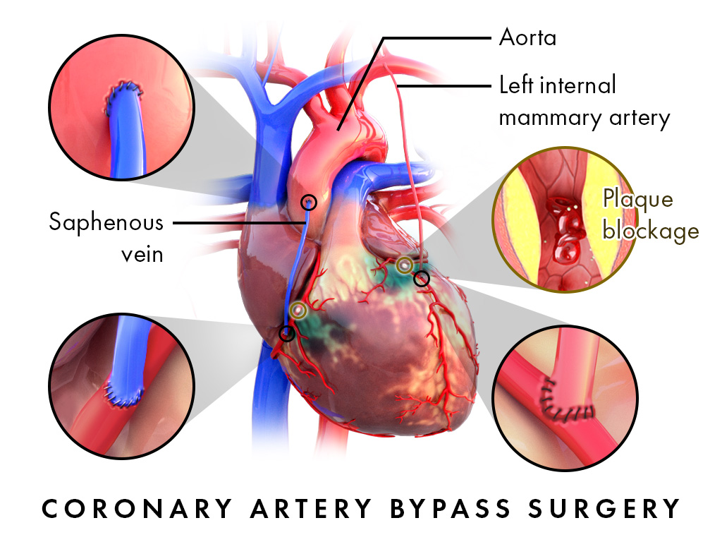 Coronary Artery Bypass Surgery in Hyderabad