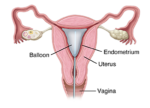 Endometrial Ablation Surgery