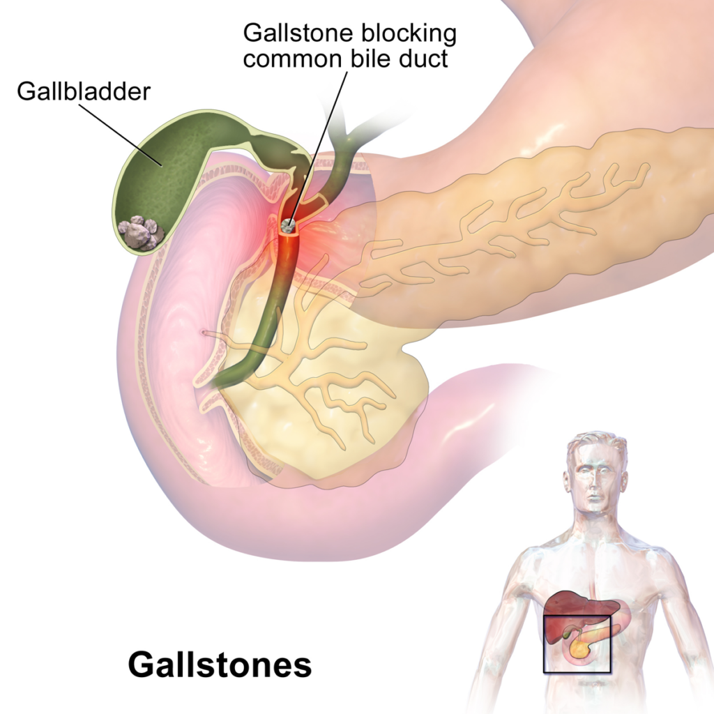 Gallbladder stones Surgery
