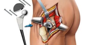 Hip Replacement Treatment