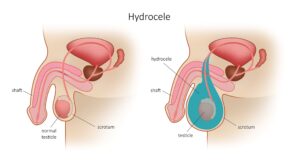 Hydrocelectomy Surgery