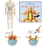 Laminectomy Spinal Decompression Treatment