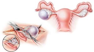Ovarian Cyst Removal Surgery