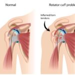 Rotator Cuff Surgery