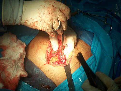 tubal ligation surgery