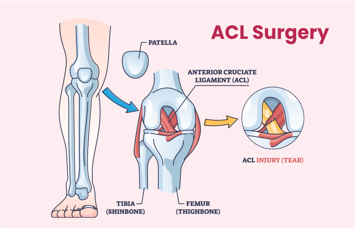 ACL Surgery