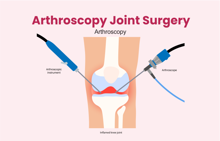 Arthroscopy Joint Surgery