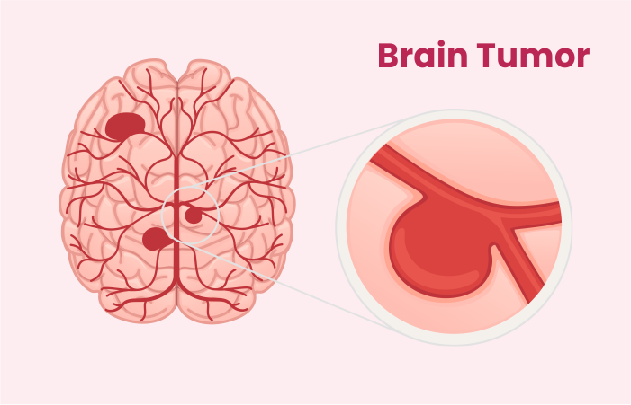 Brain Tumor