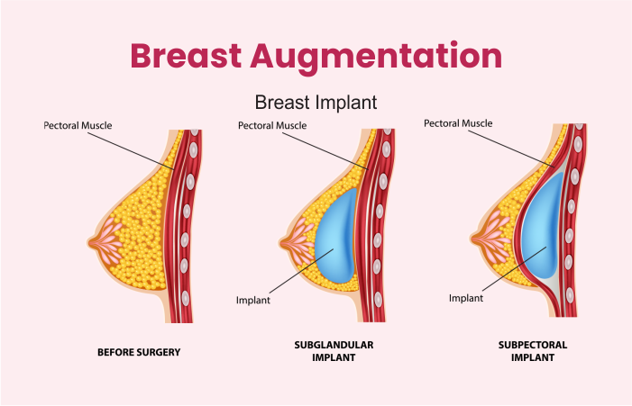 Breast Augmentation