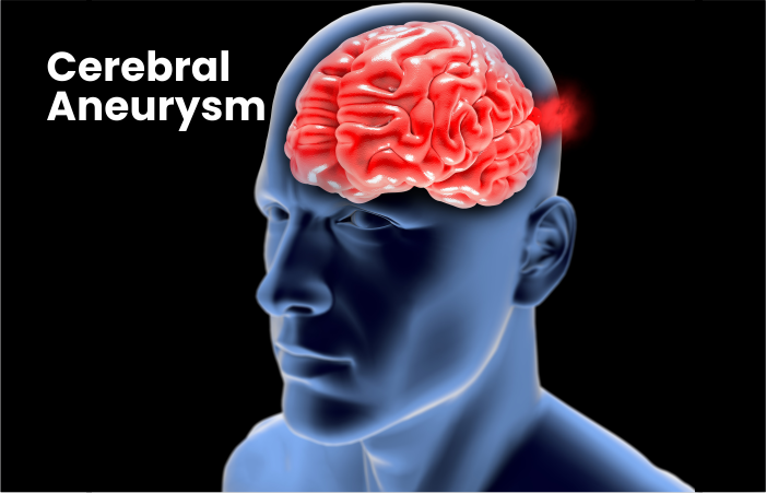 Cerebral Aneurysm