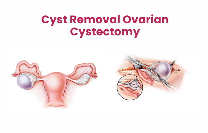 Cyst Removal Ovarian Cystectomy