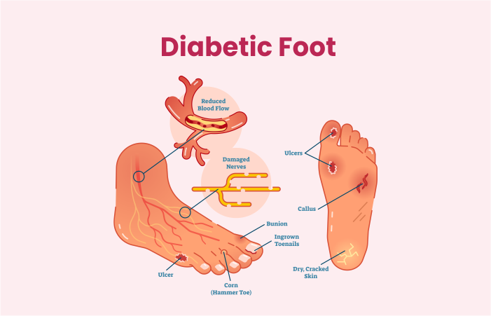 Diabetic Foot Surgery