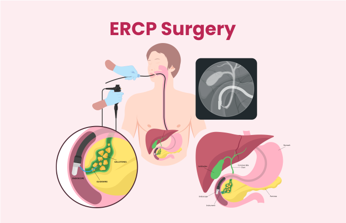 ERCP Surgery