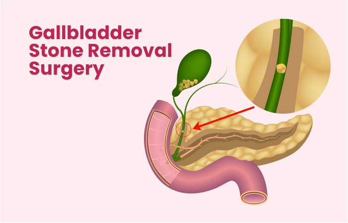 Gallbladder Stone Removal Surgery