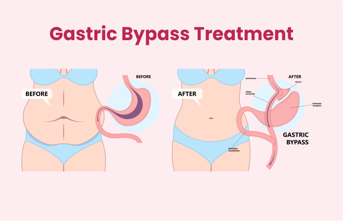 Gastric Bypass Treatment
