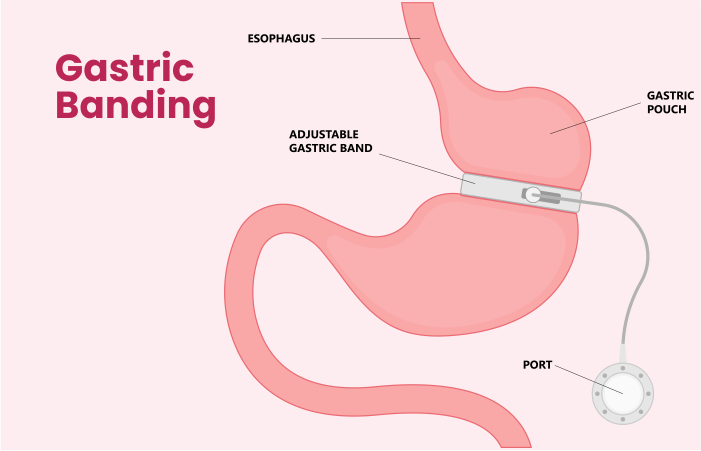 Gastric Banding Surgery