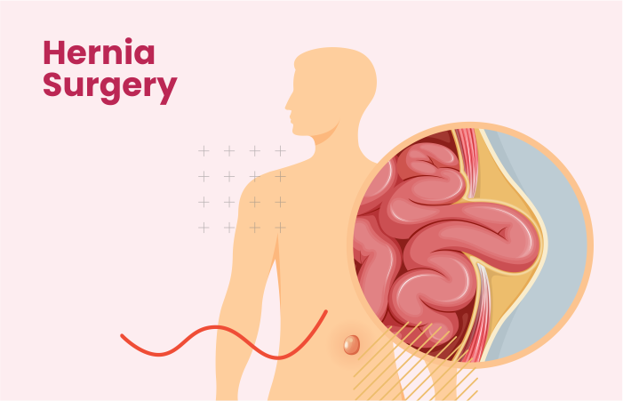 Hernia Surgery