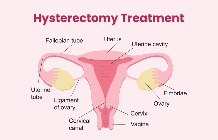 Hysterectomy Treatment