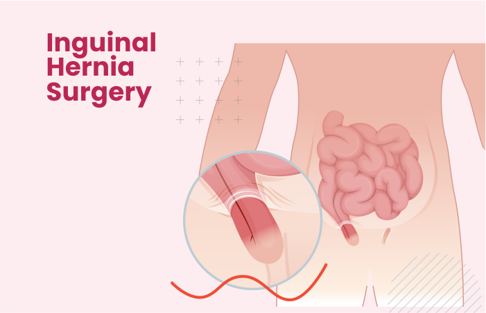 Inguinal Hernia Surgery