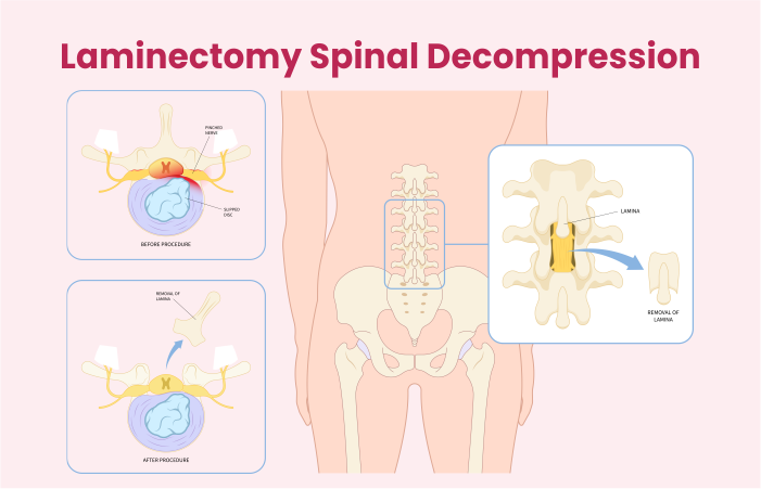 Laminectomy Spinal Decompression Treatment