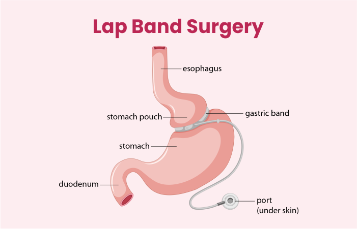 Lap Band Surgery