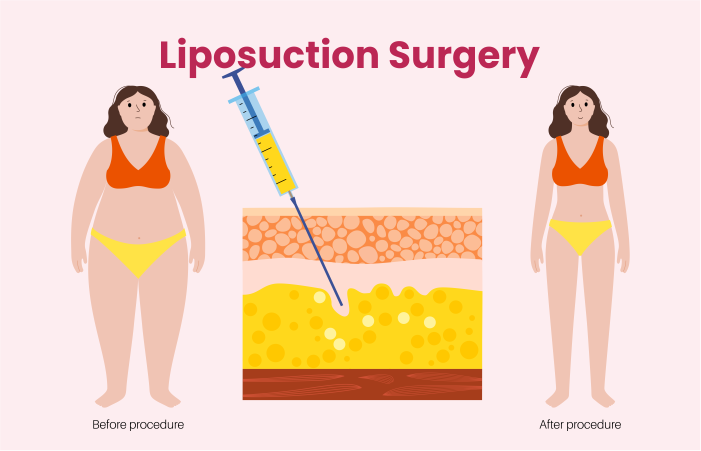 Liposuction Surgery