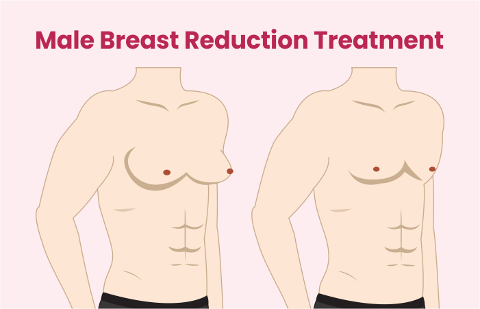 Male Breast Reduction Treatment