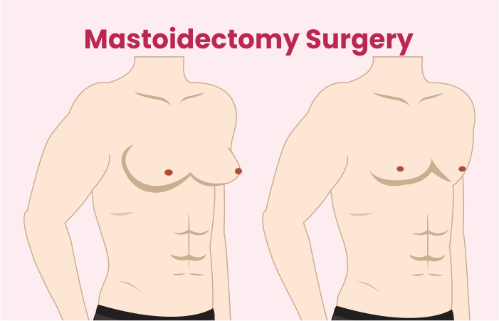 Mastoidectomy Surgery