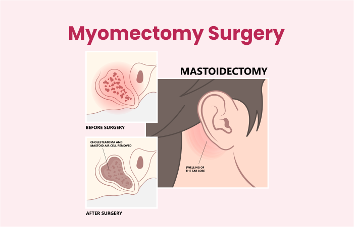 Myomectomy Surgery