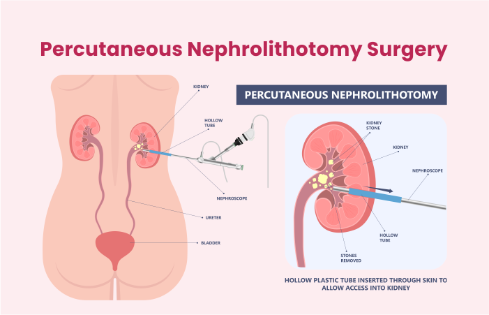 Percutaneous Nephrolithotomy Surgery