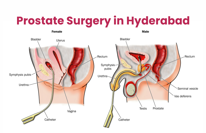Prostate Surgery in Hyderabad