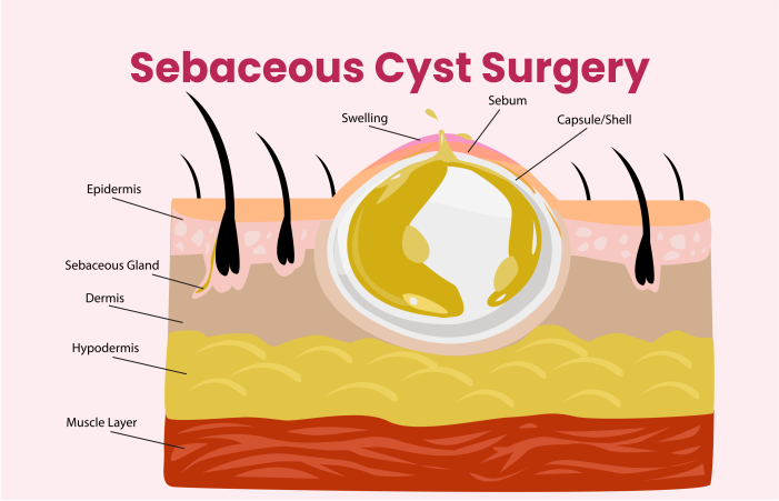 Sebaceous Cyst Surgery