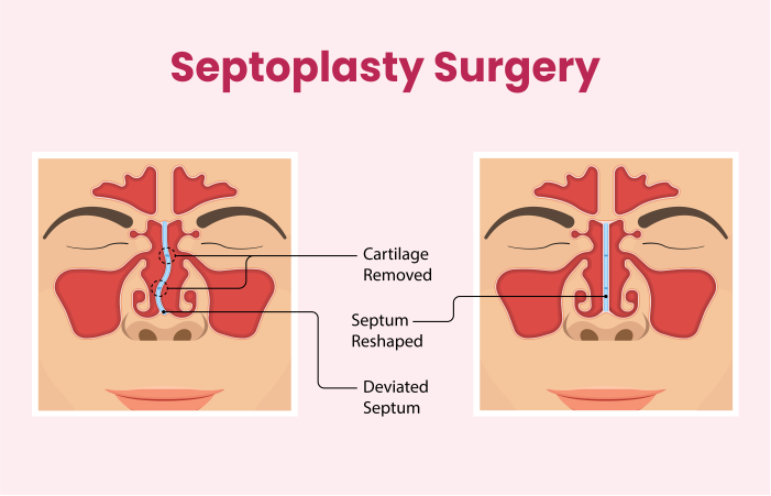 Septoplasty Surgery