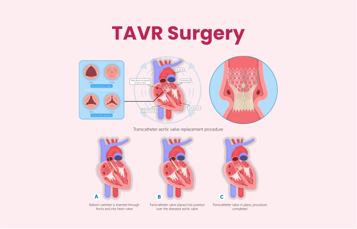 TAVR Surgery