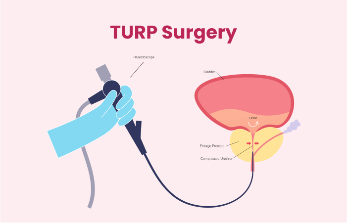 TURP Surgery