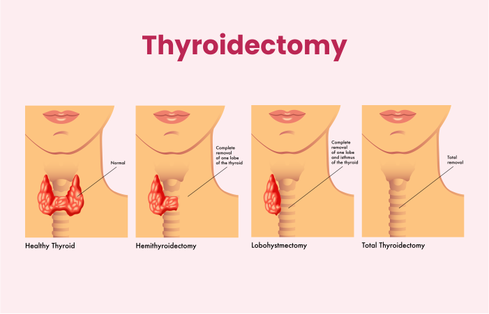 Thyroidectomy