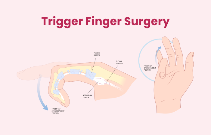 Trigger Finger Surgery