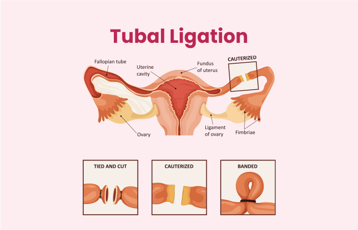 Tubal Ligation Surgery