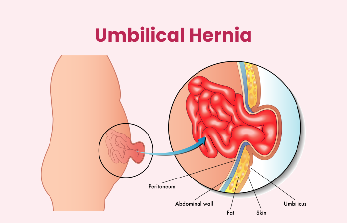 Umbilical Hernia Surgery