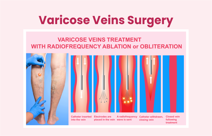 Varicose Veins Surgery